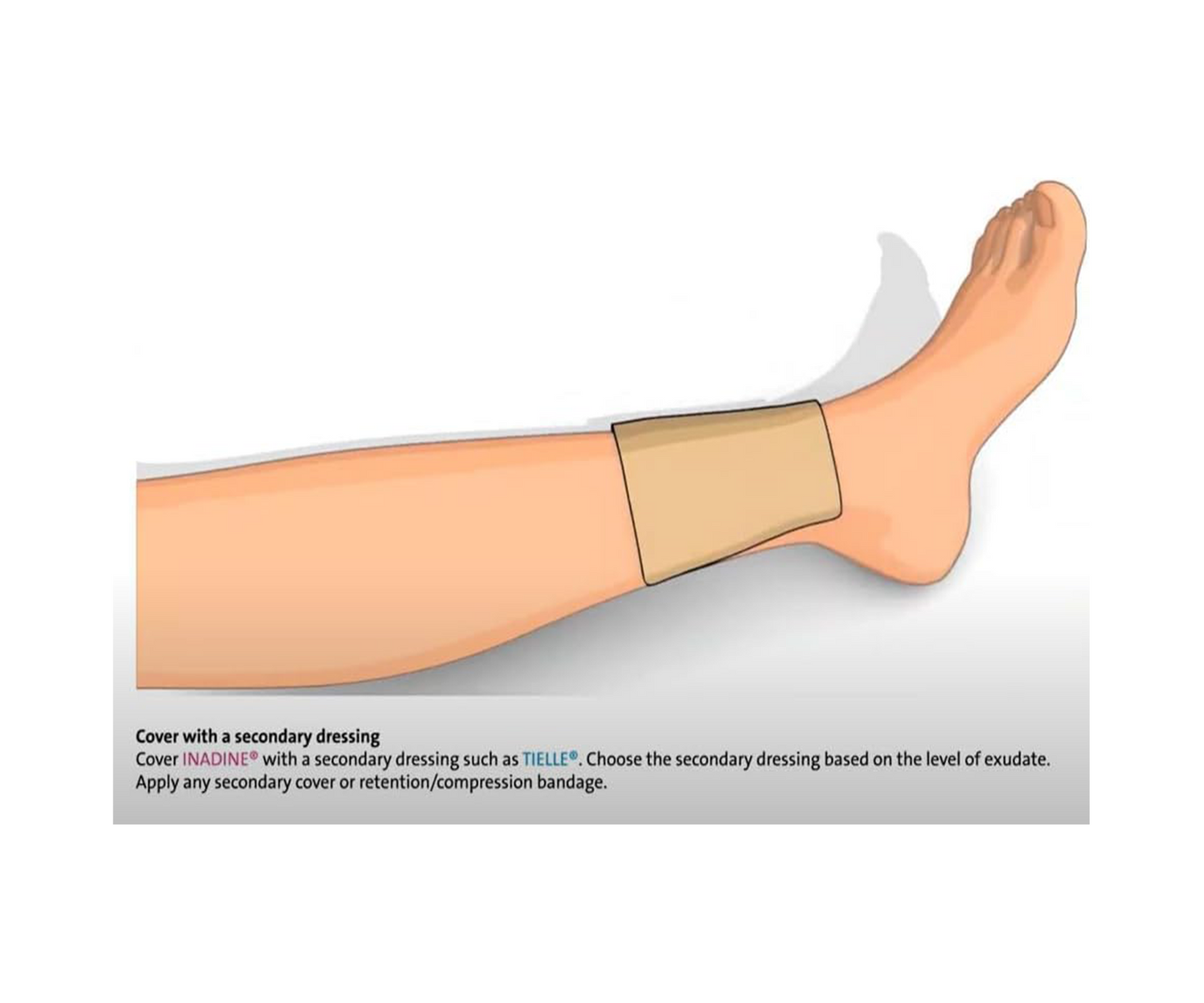 Tetra-Sole Pack of 10 Inadine Dressings (5cm x 5cm)